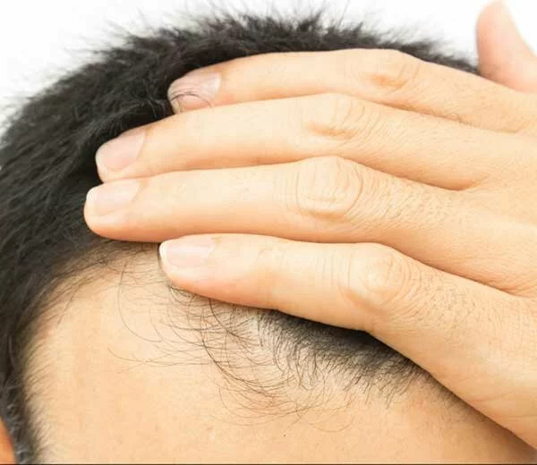 What Causes Hair Loss Receding Hairline