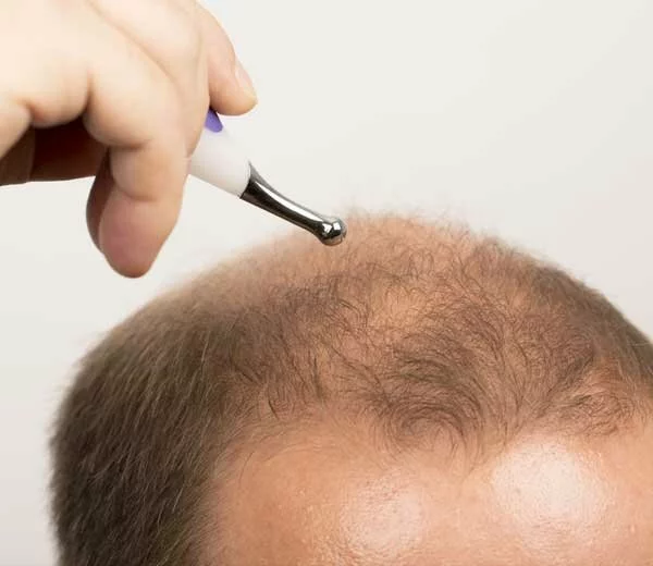 what is the best treatment for receding hairline